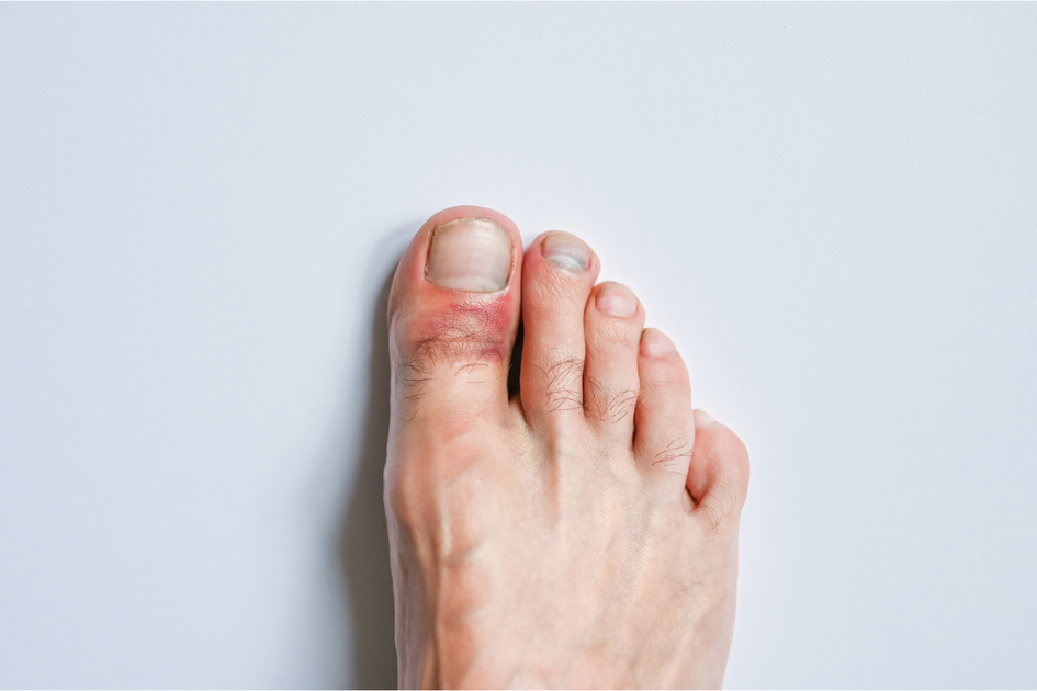 I Just Stubbed My Toe! Is it Bruised or Broken? StepStrong